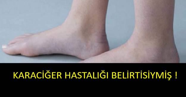 Karaciğer ihlame gelmez : Bitmekte olduğunun 4 belirtisi